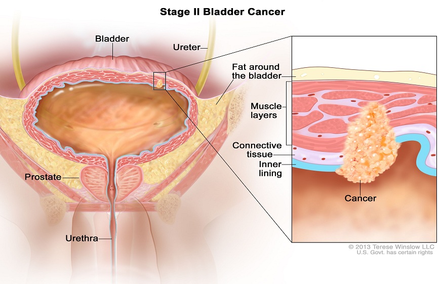 What is bladder cancer and its causes?